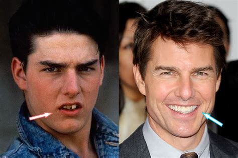 tom cruise teeth before and after